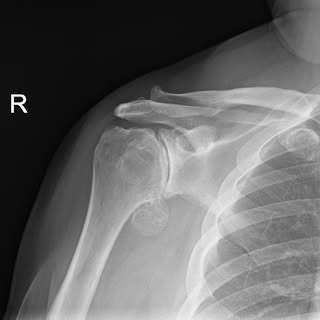 Shoulder Arthritis Treatment | Birmingham & Warwickshire
-
Shoulder arthritis can cause persistent p