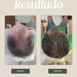 Resultado que fala por si 👏✨

Da rarefação evidente para um couro cabeludo mais preenchido, saudáve