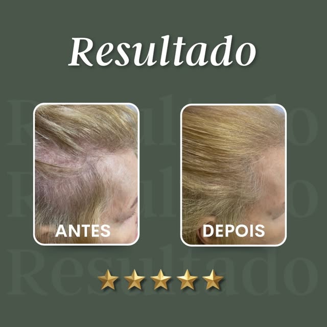 As entradas tb te incomodam? Seu couro cabeludo está aparecendo? Isso tem solução! Esse resultado fo