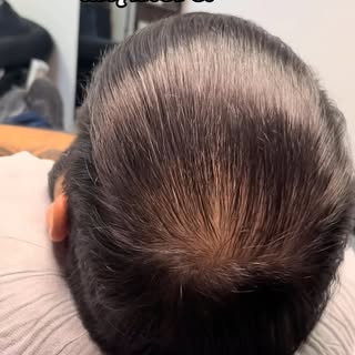 After just ONE session 👀
A natural density fill designed to reduce the appearance of thinning witho