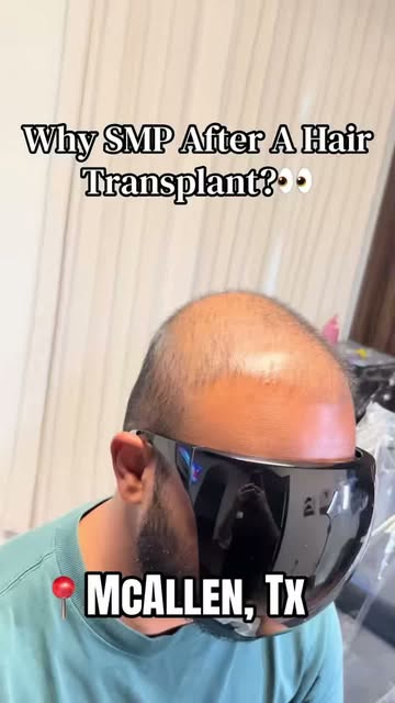 A hair transplant restores the hair… SMP creates the illusion of density. 👏🏼🔥

Even after a hair 