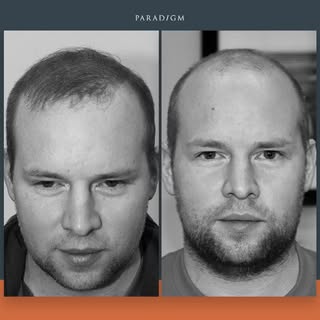 A forelock mid scalp and crown reconstruction on a young man with a Norwood 6 pattern of hair-loss. 