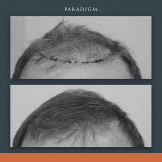 A forelock and mid scalp reconstruction on a gemtjenan with a thinning Norwood 6 pattern of hair-los