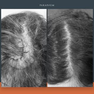 This is a lady with Female Pattern Hair-loss. Her parting has widened and the forelock has thinned. 