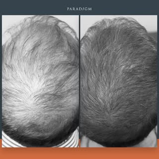 This gentleman had his forelock, mid scalp and crown transplanted over a few procedures. He naturall