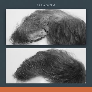 Forelock and mid scalp reconstruction on a Norwood 6 pattern of hair-loss using our unique GOFUE tec
