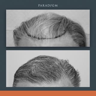 A forelock and mid scalp reconstruction of a Norwood 6 pattern of hair-loss using our unique GOFUE t