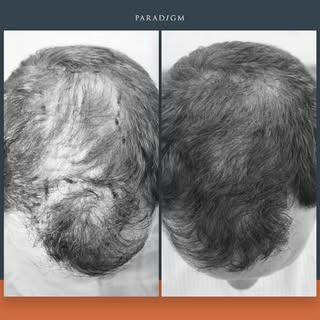 A forelock and full mid scalp transplant using our unique GOFUE technique. 

#fue #hairtransplant #h