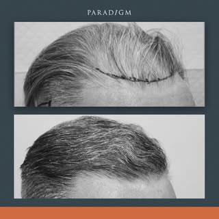 A testimonial from one of our patients:

Paradigm

I was totally surprised by my rapid hair loss and