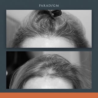 Disguising a scar with hair transplantation using our Growth Optimised FUE technique. 

#scar #fue #
