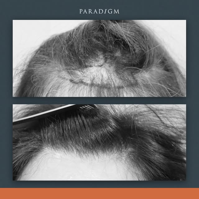 A forelock transplant can enhance the forelock so that you can grow a fringe again. 

#hairlossinwom