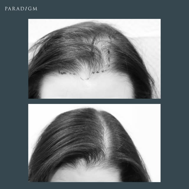 A forelock and parting transplant. 

#femalehairtransplant #femalehairloss