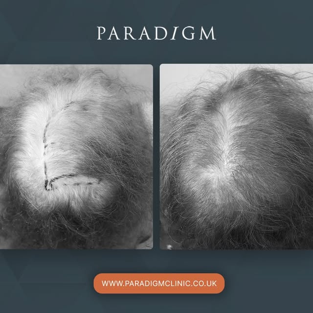 A mid scalp hair transplant for female hair-loss. 

#hairlossinwomen #femalehairtransplant #hairtran