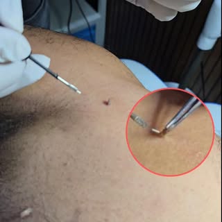 Skin tag removal 👉🤗
