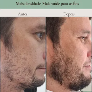 Nem sempre “estimular mais” é a resposta!

Esse é o resultado de um paciente que desejava uma barba 