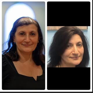 Women’s hairloss - find out options at PositiveHair  #hairreplacement#hairlossspecialist #hairtopper