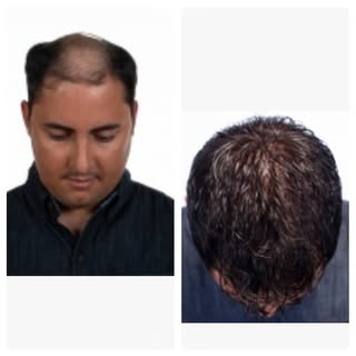 Ask PositiveHair what you can do about your hair loss ! Call for a consultation.  903-561-9697  #mal