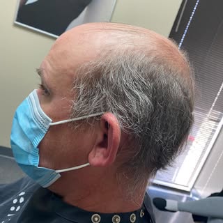 Swipe to see the afters 👉  menshairloss#hairreplacement#  hairlosssolutions#alopecia#  Contact Posi