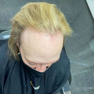 Frontal Fibrosing Alopecia-gradual hairloss of the hairline.  Find out what solutions PositiveHair h