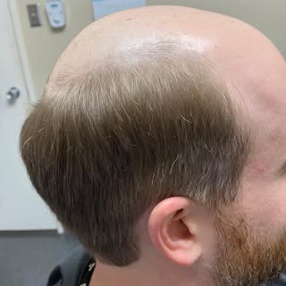 Get results now! Ask us how! Our  speciality is customizing something just for you. #menshairreplace