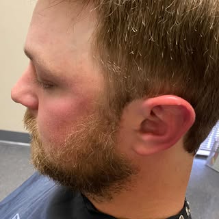 Men’s hair replacement #positivehairrestoration