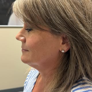 Women’s hair replacement  #womenstopper#volume#hairloss