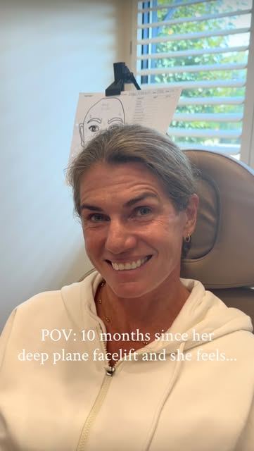 Ten months out from a deep plane facelift, neck lift, and full face fat grafting.

She’s active, she
