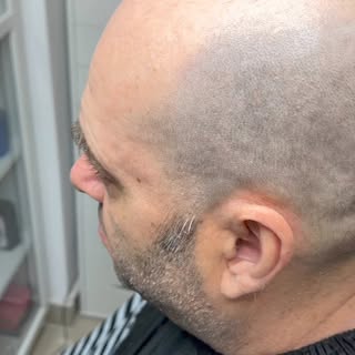 Micropigmentarea scalpului este o metodă de tatuaj medical în care se imită perfect foliculul de păr