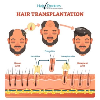 ➥Hair Transplant Process.
➥What are the steps of a hair transplant procedure? ➥To Get More Info Visi