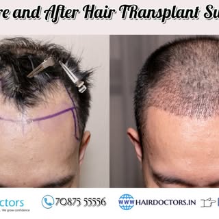 Before and After Hair Transplant.
Regrow your hair with 100% assurance.
Get FUE Hair Transplant
If Y