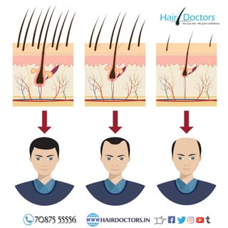 Different stages of hair loss
If you are suffering from any hair loss issue, you should schedule an 