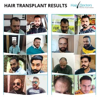 #HairDoctors - Not Just #Hair We Grow Confidence

Our  Hair Transplant Patient Results.

Get a #Free