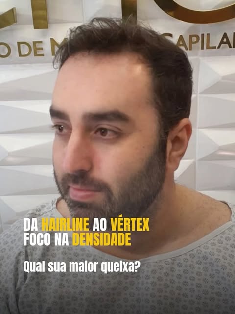 Testa alta e calvície?

Como o transplante capilar pode reconstruir a hairline em quem tem testa a