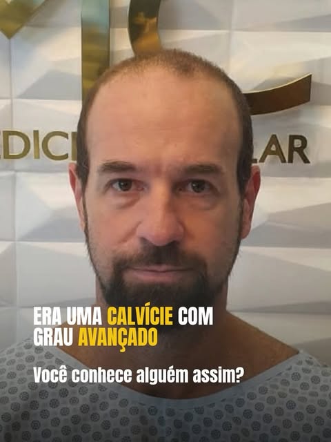 Calvície avançada tem solução?

Calvície avançada com poucos fios: o transplante capilar pode recu