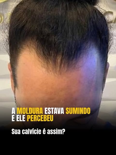 Hairline e testa alta?

Como o transplante capilar pode reconstruir a hairline em quem tem testa a