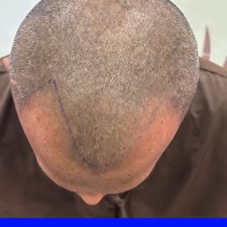 ✨ Grade 3 Baldness Transformation | Hair Transplant by Dr. Amit Porwal ✨

Grade 3 baldness doesn't h