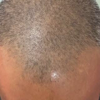 Is your receding hairline spoiling your hairstyle? It’s time to redefine your hairline! 🔥”

✨ Grade