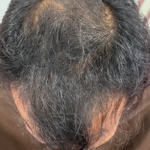 ✨ Transformation That Speaks for Itself! ✨

A remarkable Hair Transplant transformation for Grade II