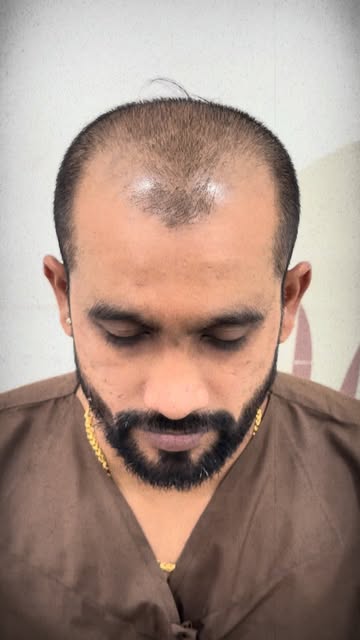 Sir, I want my hairline like it was in 2019…” ❤️

A simple wish.
A clear goal.
And a transformation 