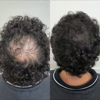 ​Cansado de ver seu cabelo diminuir a cada dia? 😩
​Essa é a jornada de muitos de nossos pacientes a