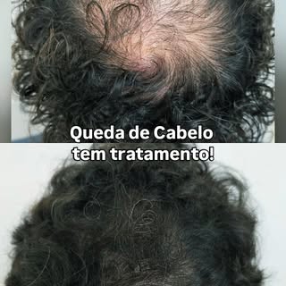 🚀Queda de Cabelo tem Tratamento! Quer saber o que ele fez pra ter esse resultado? Fez 2 coisas: esc