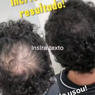 🎊Queda de Cabelo tem tratamento! Gabriel é a prova viva que o tratamento funciona. Ele já tinha usa