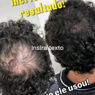 🎊Queda de Cabelo tem tratamento! Gabriel é a prova viva que o tratamento funciona. Ele já tinha usa