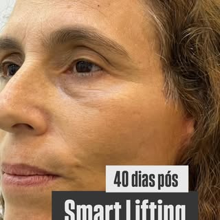 40 dias de pós-operatório… e cada detalhe começa a revelar a beleza do processo. ✨

O Smart Lifting 