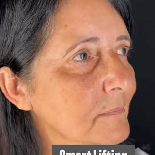 1 dia. Apenas 24 horas.

É impressionante como o Smart Lifting já demonstra seu potencial logo nas p