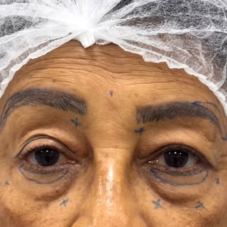 O rejuvenescimento começa no centro da expressão: o olhar.

Este é o resultado imediatamente após um