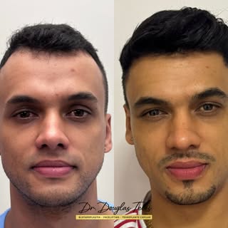 Às vezes, o detalhe que falta é justamente o que muda toda a percepção do rosto.

Um transplante cap