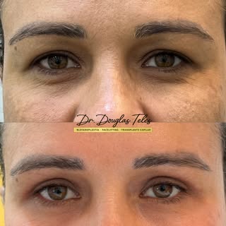 ✨ O olhar muda. A expressão se transforma. A naturalidade permanece.

Neste antes e depois da blefar