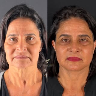 O lifting facial é um procedimento que busca proporcionar um rejuvenescimento facial, valorizando os