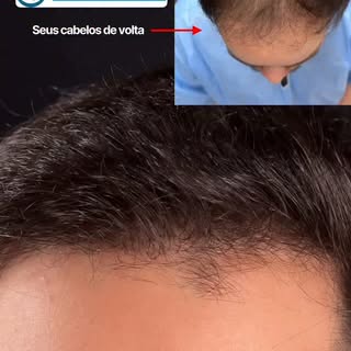 1 ano depois. O resultado fala por si.

Não se trata apenas de recuperar fios. Trata-se de recuperar